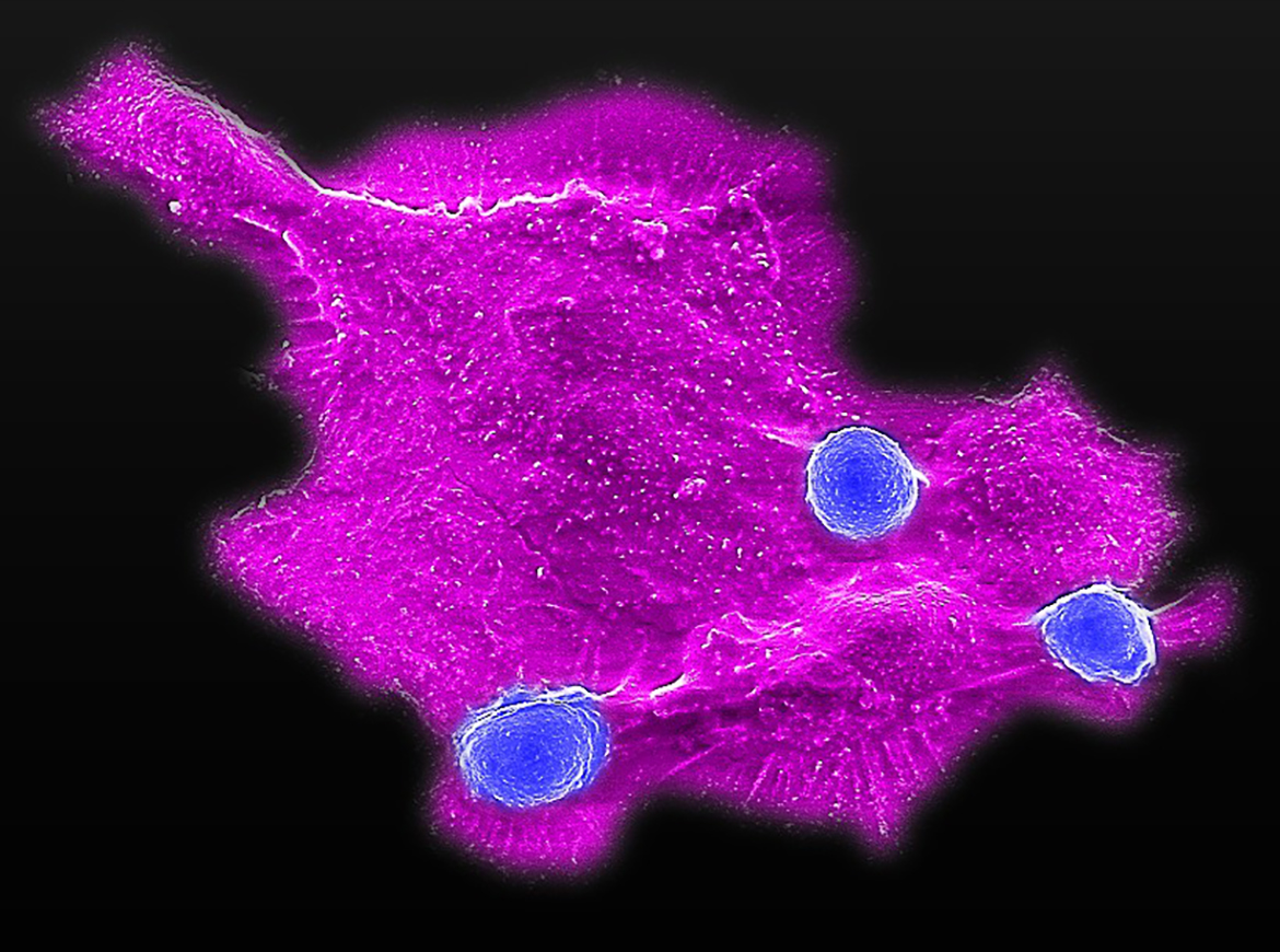 Microscopy image showing blood stem cell-engineered CAR-NKT cells (three blue dots) attacking a human solid tumor cell (magenta)