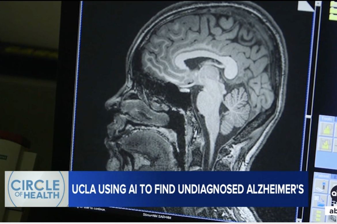 UCLA AI tool captures 80% of undiagnosed Alzheimer’s cases