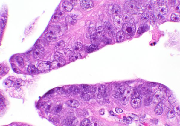 Microscopy image showing uterine papillary serous carcinoma tissue stained in shades of pink and purple. The image reveals finger-like projections of cancerous cells with large, irregular nuclei characteristic of this aggressive form of endometrial cancer.