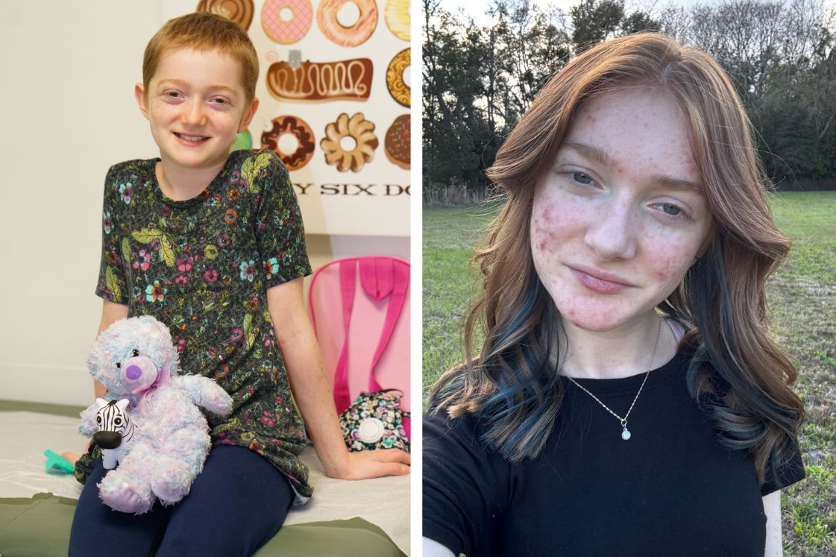 A composite image shows Marley Gaskins, the first patient to enroll in the LAD-I clinical trial, as a young child holding a stuffed animal in a clinic (left), and as a teenager outdoors (right).