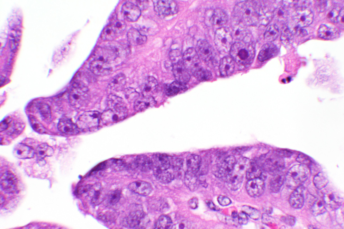 Microscopy image in purple of uterine papillary serous carcinoma, an aggressive subtype of endometrial cancer.