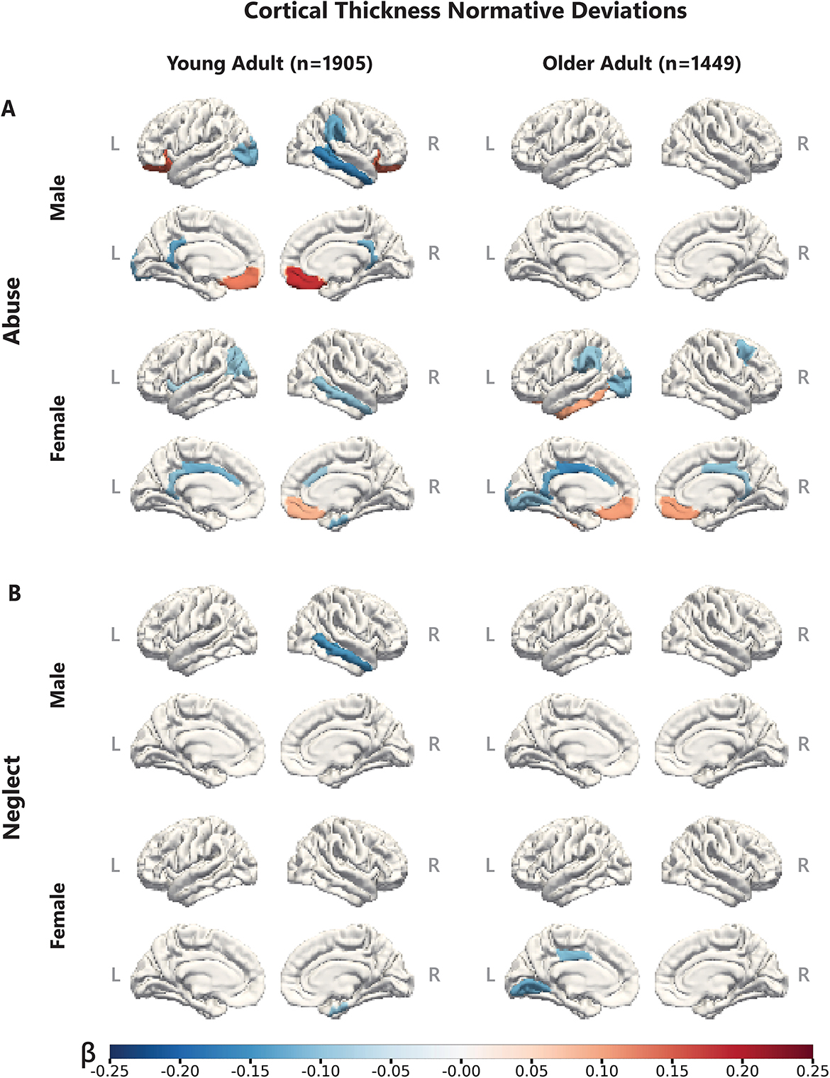 Comparison in cortical thickening in the brains of people who had experienced childhood maltreatment vs. neglect.