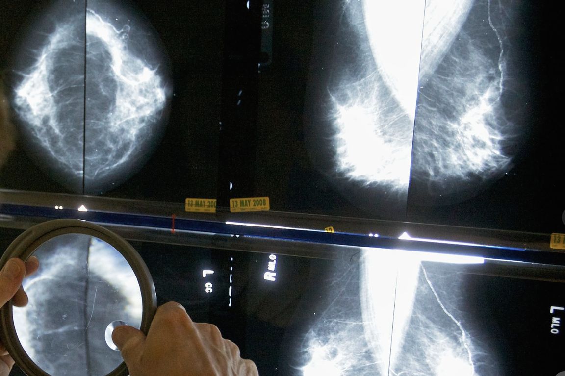 A radiologist uses a magnifying glass to examine mammogram images displayed on a lighted screen while screening for signs of breast cancer.
