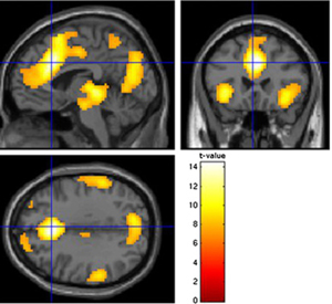Sample activity in a brain image at a time when impulsive behavior is under consideration.