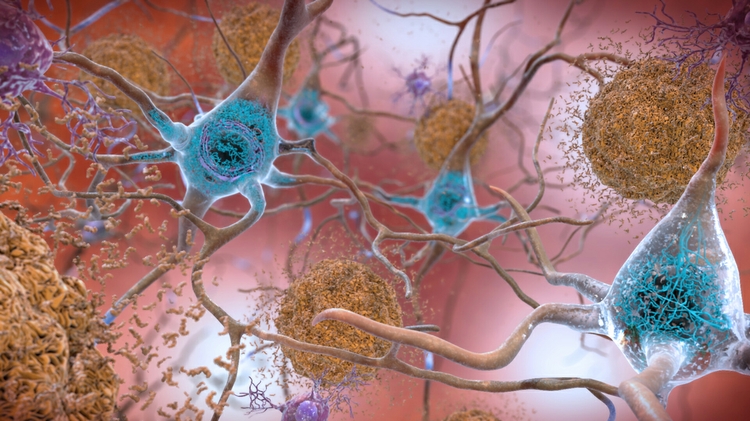In the Alzheimer’s affected brain,