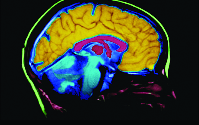 UNMH stroke team delivers new 'gold standard' of care