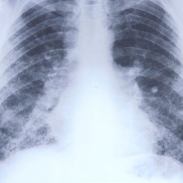Faces of Dust-Related Diseases