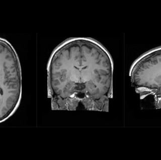 Brain scans performed by King's College London