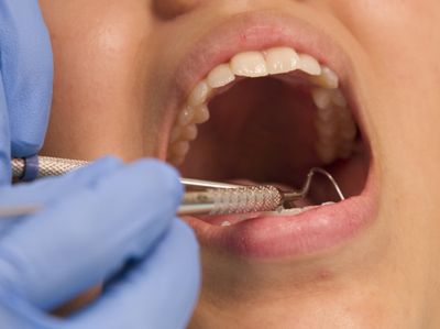 Dental exam - woman's mouth