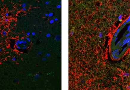Alzheimers Cognitively Vessels