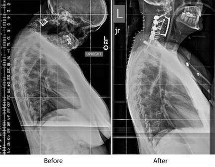 Surgery corrects dropped head syndrome 2016