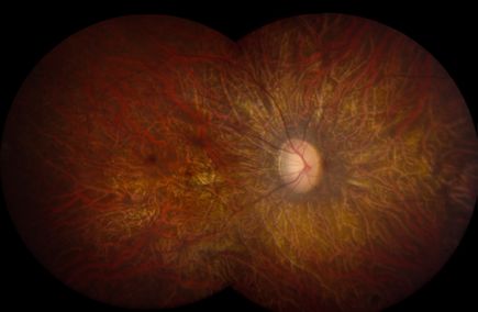 Retina with LCA (photo credit: National Eye Institute)