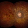 Retina with LCA (photo credit: National Eye Institute)