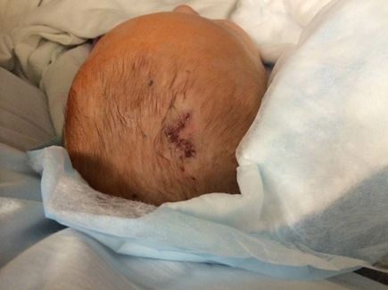 Hydrocephalus: ETV Incision