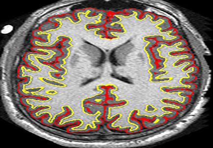 Slowing MS brain shrinkage