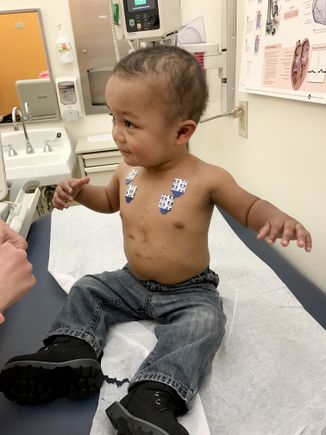 Pediatric congenital heart defect