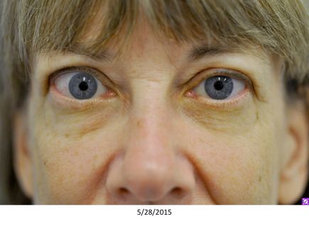 Thyroid eye disease treatment