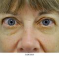 Thyroid eye disease treatment
