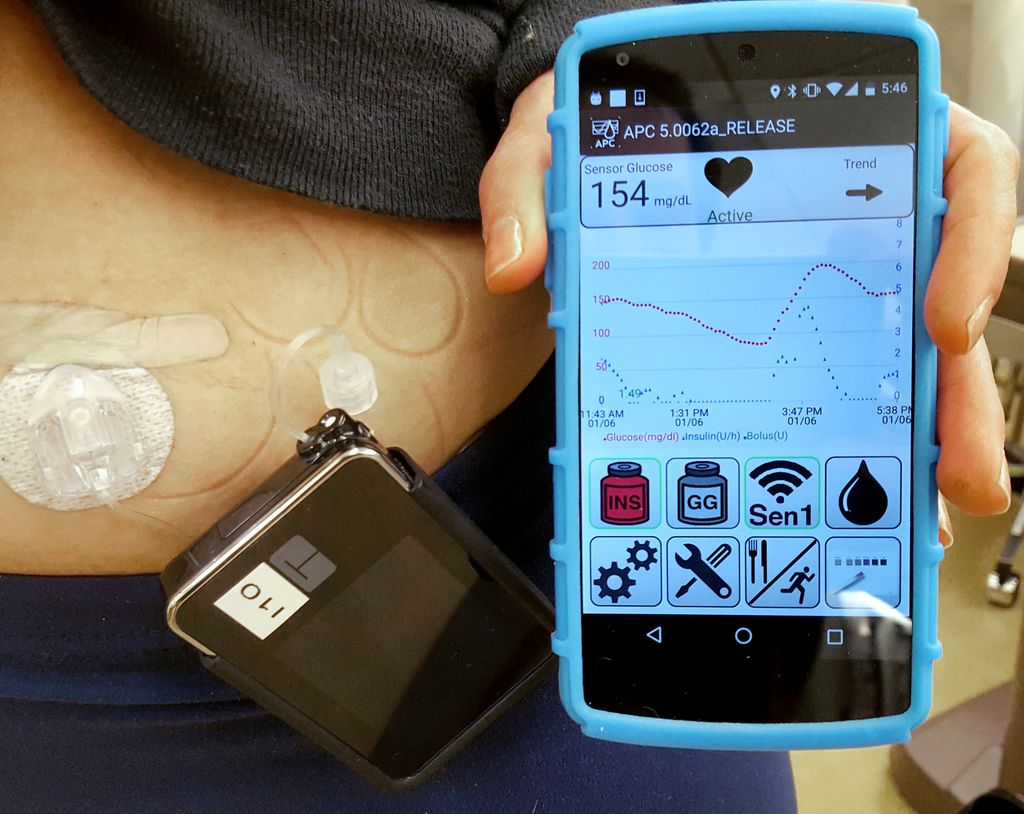 People with diabetes monitor hypoglycemic events using a device known as a continuous glucose monitor, or CGM. A new algorithm called Glucop30 will allow CGM devices to predict hypoglycemia events more accurately up to 30 minutes in advance, which helps patients better facilitate blood sugar level management. (OHSU/Peter Jacobs) person with diabetes monitor attached, and holding up a phone with the readout of their glucose levels