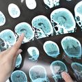 Stroke care dwindles worldwide during pandemic, study finds