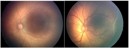 Retinopathy of prematurity 