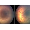 Retinopathy of prematurity 