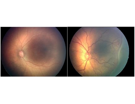 Retinopathy of prematurity 