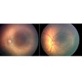 Retinopathy of prematurity 