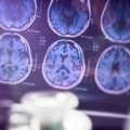 Discovery raises possibility of new medication for Alzheimer’s, Parkinson’s
