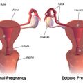 Normal vs Ectopic Pregnancy