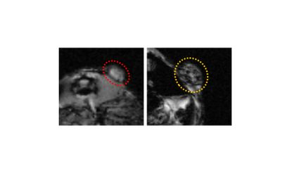 Nanotechnology and endometriosis