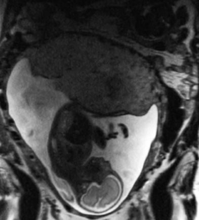MRI baby in utero
