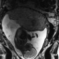 MRI baby in utero