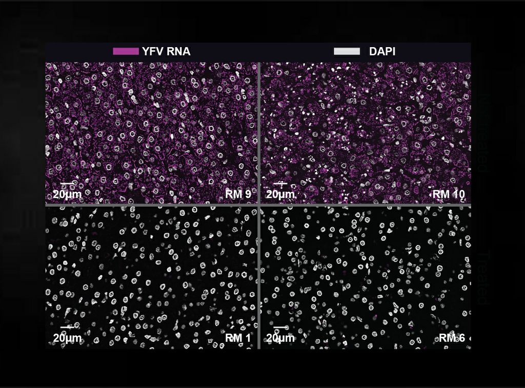 Esta imagen agrandada, tomada a través de un microscopio, muestra que el virus de la fiebre amarilla (con coloración violácea) está por debajo de los niveles detectables en la sangre de los animales de estudio que recibieron tratamiento con anticuerpos monoclonales después de haber estado expuestos al virus (cuadros inferiores). En comparación, el virus de la fiebre amarilla es claramente visible en la sangre de animales de estudio que no recibieron anticuerpos monoclonales (cuadros superiores). Este estudio sugiere que los anticuerpos creados en laboratorio podrían permitir curar a personas que se enferman por el virus de la fiebre amarilla, una enfermedad para la que no existe tratamiento. (OHSU)