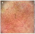 Encontrar melanoma