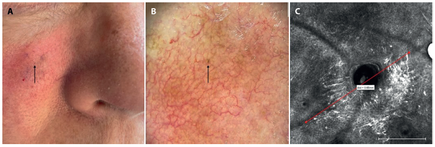 Finding melanoma