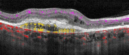 Optical coherence tomography angiography