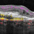 Optical coherence tomography angiography