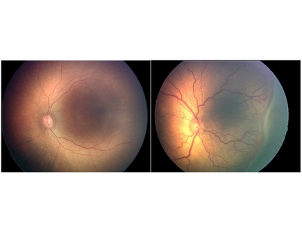 ROP eyes_padded