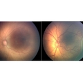ROP eyes_padded