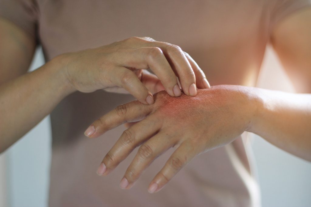A person itching their skin due to eczema flare up. OHSU research shows dupilumab alleviated the skin lesions and intense itching that is common in eczema. (Getty Images)