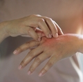 Eczema drug shows promise in clinical trials 