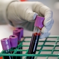 Investigadores/as de OHSU desarrollan prometedor fármaco para cáncer de mama agresivo