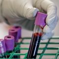 OHSU researchers develop promising drug for aggressive breast cancer