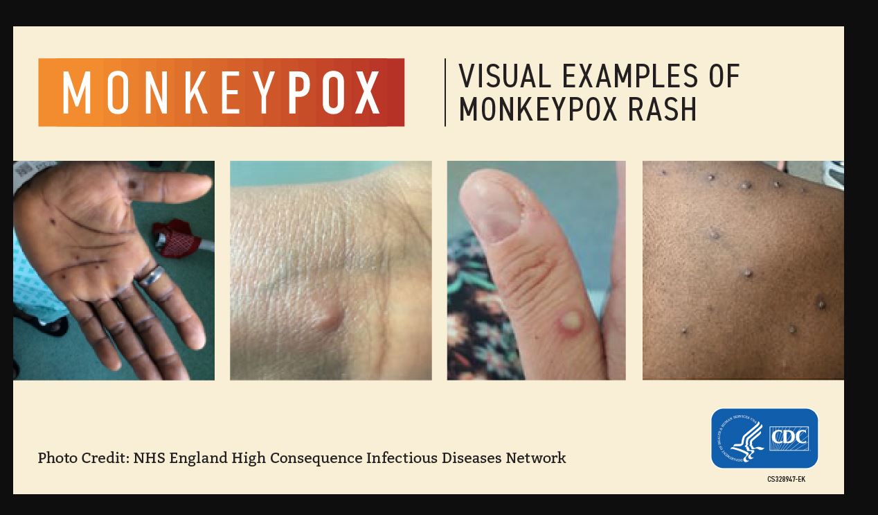 monkeypox