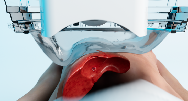 Novant Health is first in the Carolinas to offer histotripsy for liver cancer