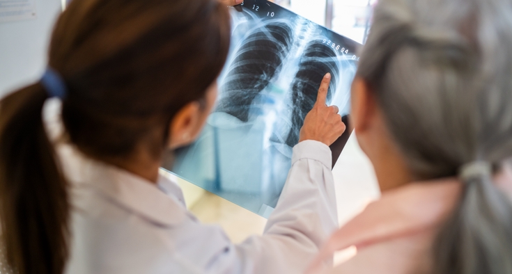 Lung cancer screening saves lives. Do you need it?