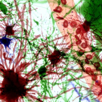 Research to Treat Neurodegenerative Diseases Advances: URMC Start-up Acquired