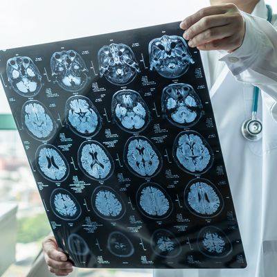 ABCD Study MRIs reveal more incidental findings in children