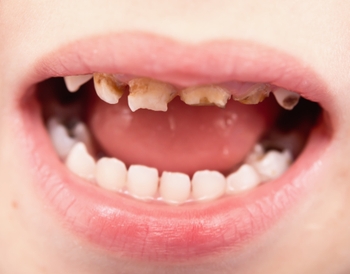 child's teeth with tooth decay